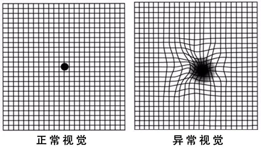 糖尿病患者出現(xiàn)這個(gè)癥狀，可能是失明前兆