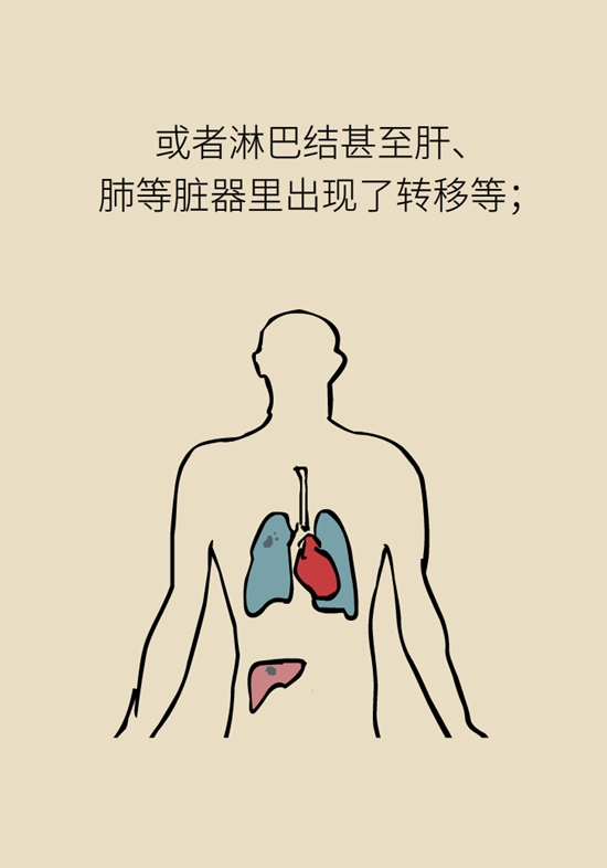 乳腺癌復(fù)發(fā)、轉(zhuǎn)移了怎么辦？