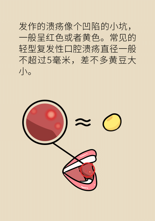 口腔潰瘍醫(yī)學(xué)知識(shí)科普動(dòng)漫制作